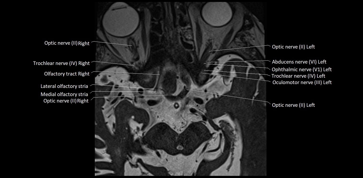 Cranial nerve anatomy axial MRI 3T image 12.webp